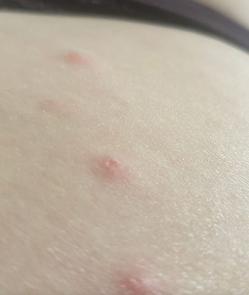How to Identify 10 of the Most Common Bug Bites: Symptoms, Differences, and When to Seek Help