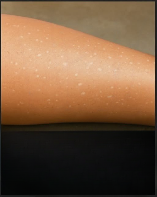 What Vitamin Deficiencies May Lead to White Spots on the Skin