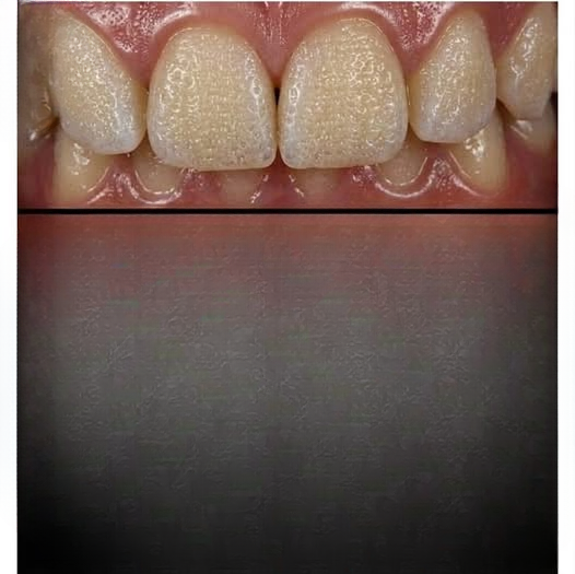 Does Rice Help Whiten Teeth? A Closer Look at a Popular DIY Trend