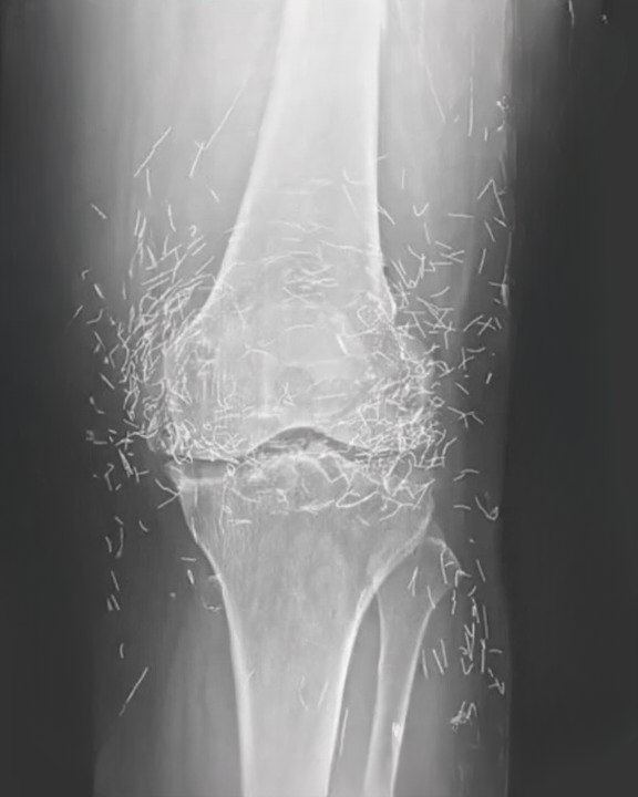 Doctors Discover Unexpected “Gold Deposits” in Patient’s Knees: A Real Case That Highlights Risks and Lessons in Alternative Treatments