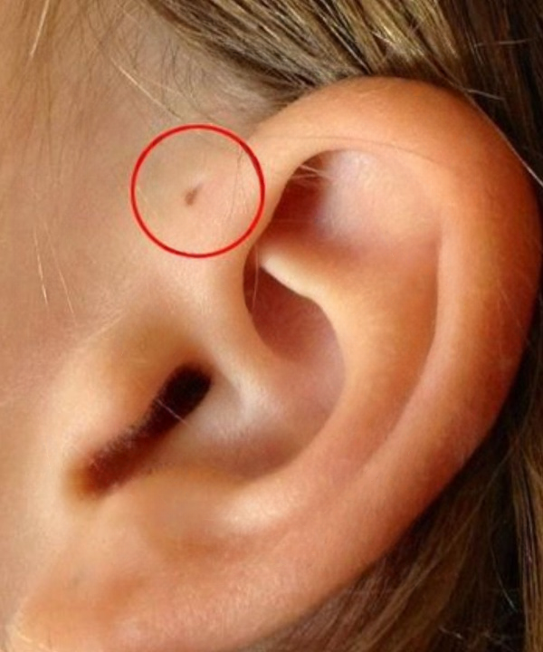 What That Tiny Hole Near the Ear Really Means: A Harmless Genetic Trait With Ancient Origins