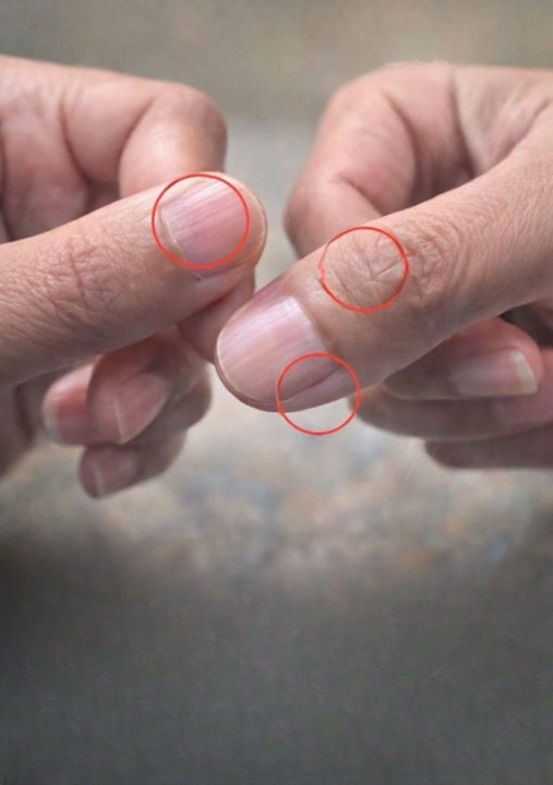 Vertical Nail Ridges: Why They Become More Noticeable with Age and What You Can Do About It