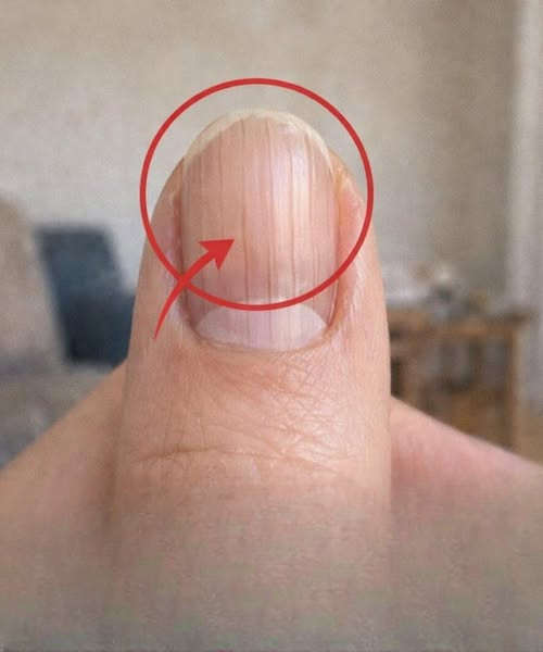A Doctor Noticed Something Subtle in Fingernails—And It Might Reveal More About Your Health Than You Think