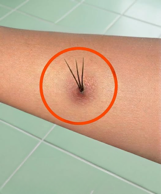 I Thought Something Was Growing Out of My Skin After a Hike — The Truth Was Much Simpler