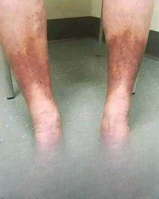 Understanding Swollen Feet: Causes, Symptoms, Prevention, and When to Consult a Healthcare Professional