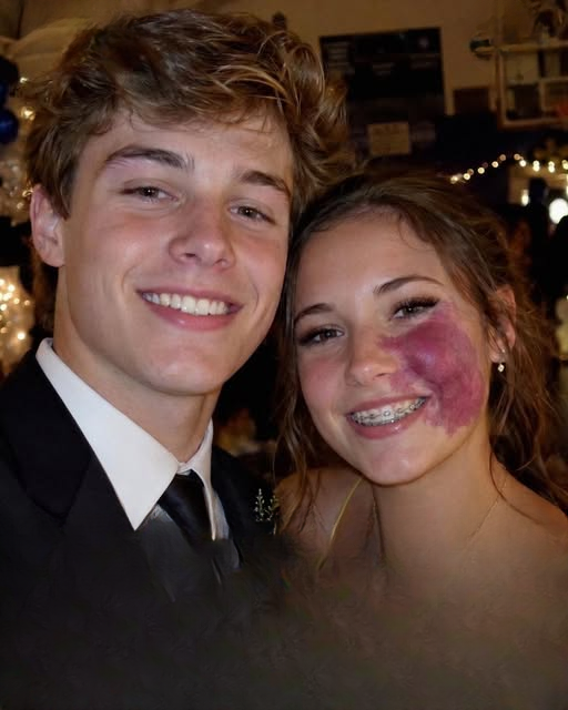 Only One Boy Asked Me to Prom Because No One Else Wanted to Due to the Birthmark on My Face – Everyone Laughed Until an Officer Walked Into the Hall