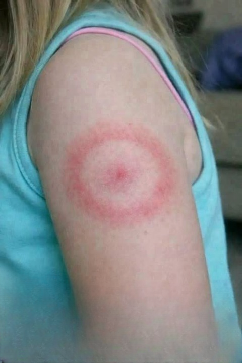 Ringworm Explained: The Hidden Fungal Infection That Can Affect Your Skin, Hair, and Nails